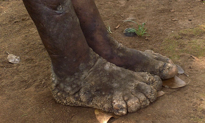 'Volcanic soils, not worms causing elephantiasis in Kamwenge' 'Volcanic soils, not worms causing elephantiasis in Kamwenge'