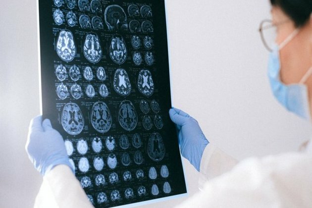 Alzheimer's disease can be diagnosed with single brain scan: Research
