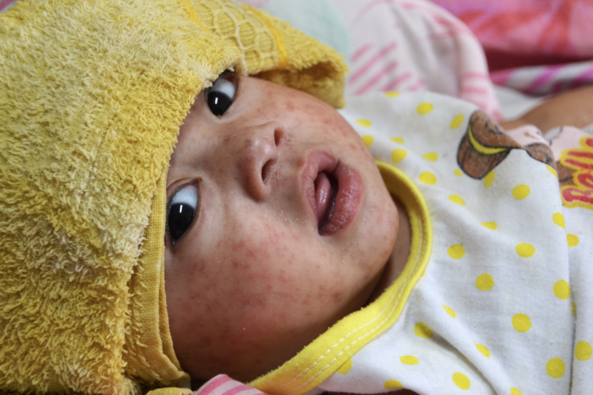 Measles erases immunological memory