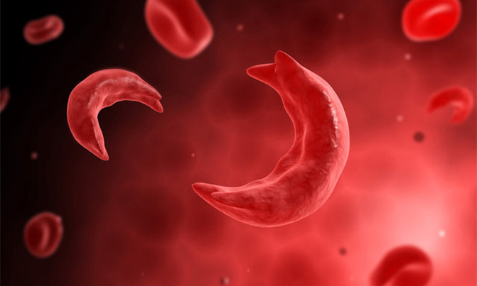 Sickle Cell blood story competition unveiled Sickle Cell blood story competition unveiled
