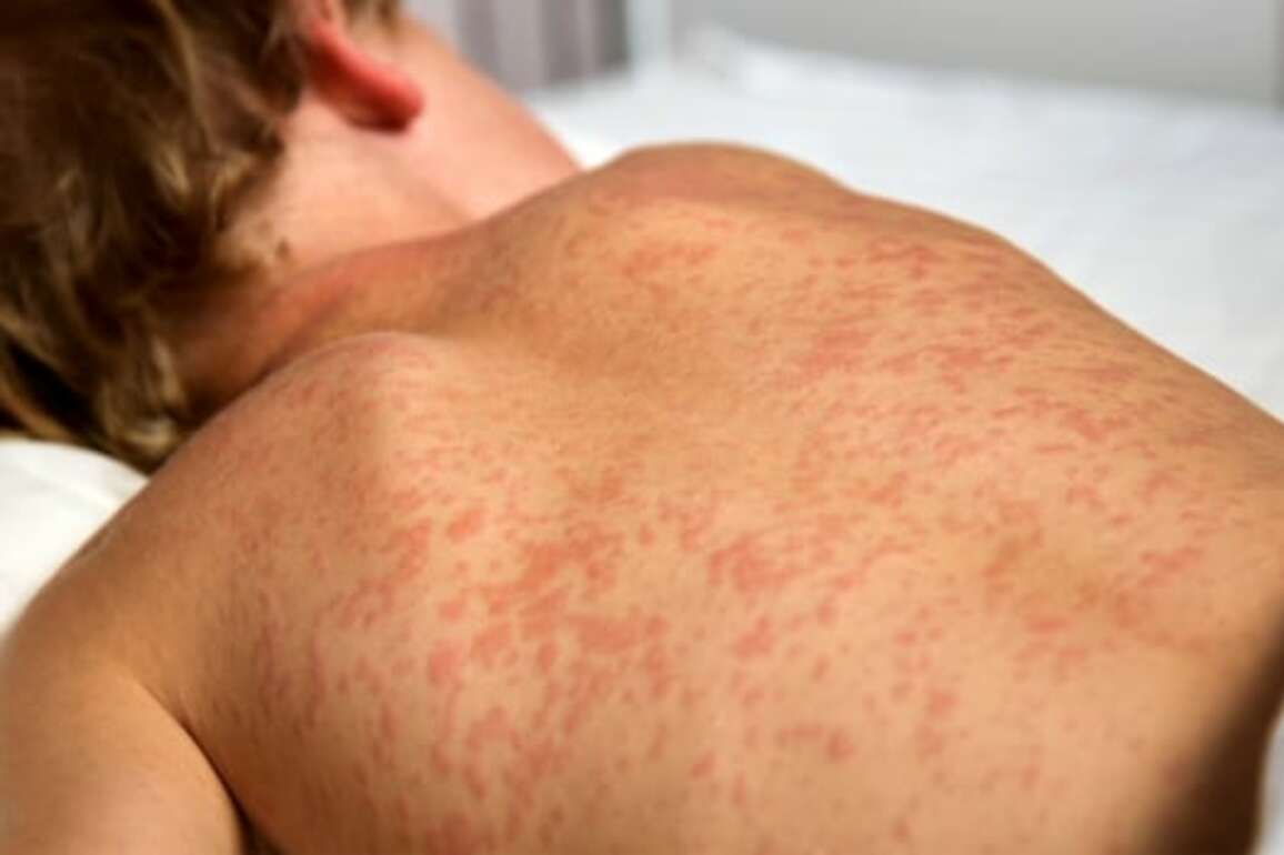 Why are measles case counts climbing so high in Alberta&quest; Experts weigh in