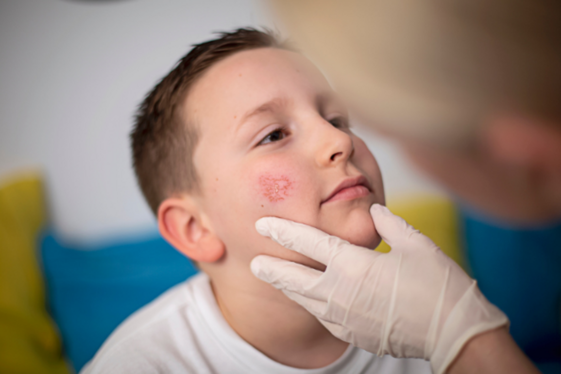 Michigan reports first confirmed outbreak of measles since 2019