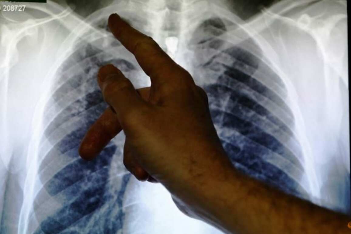 Commentary- Were losing ground in the global fight against tuberculosis