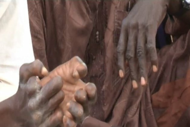 WHO: Over 1.6B People Infected with Neglected Tropical Diseases