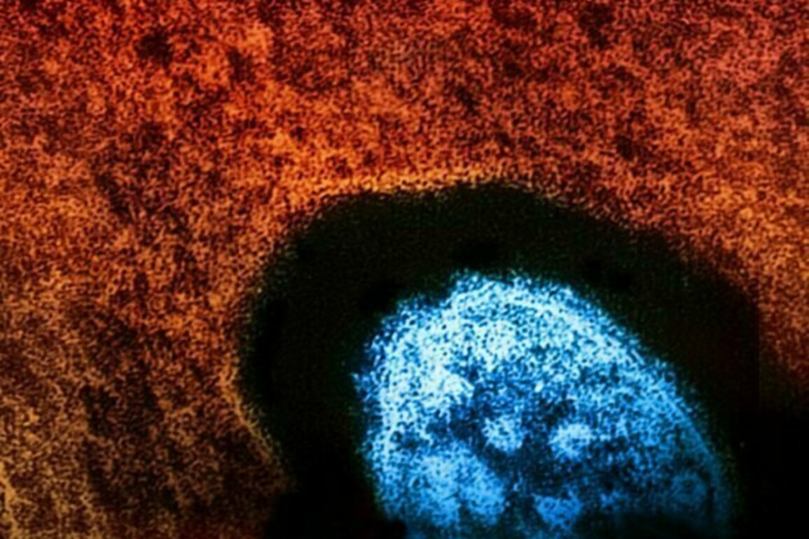 Measles: A resurgent threat in Canada