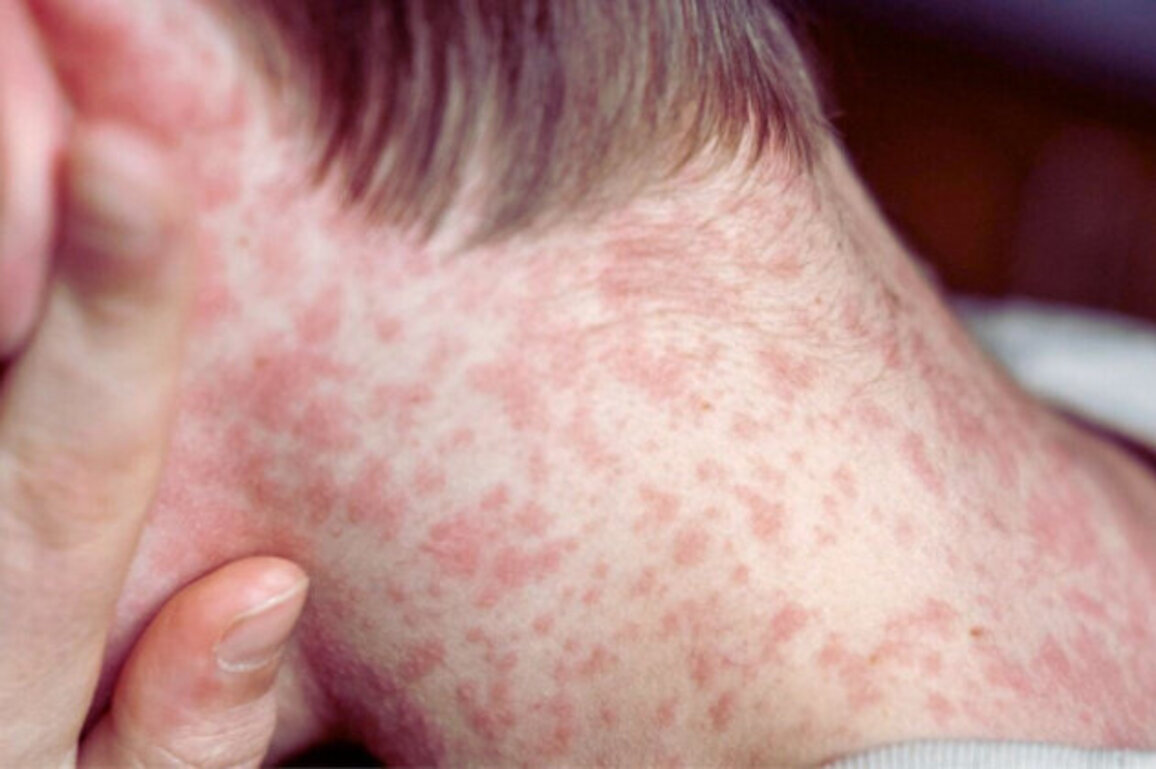 Measles Cases in Bulgaria Rise to 43, Majority Among Children