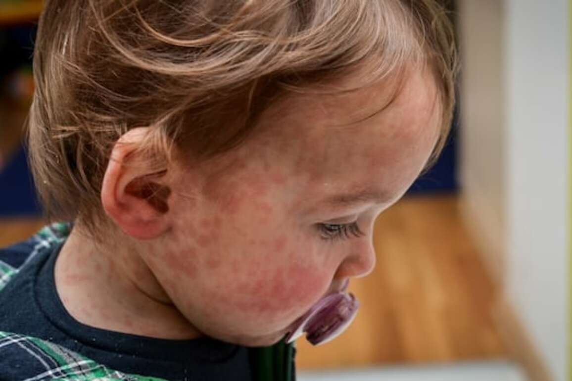 Vaccine skepticism a growing concern, virologist warns amid rising measles caseload