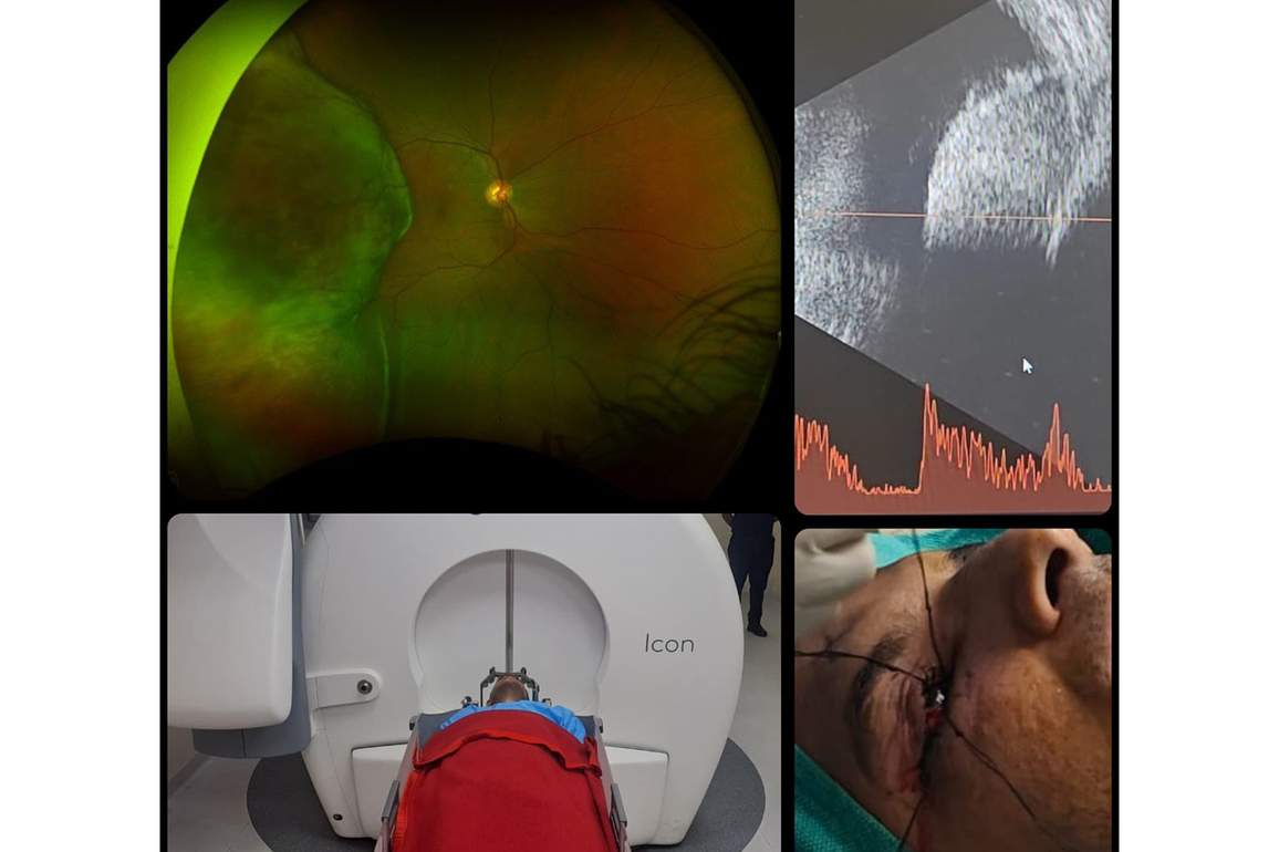 Army Hospital performs Gamma Knife Therapy on 38-year-old serving officer