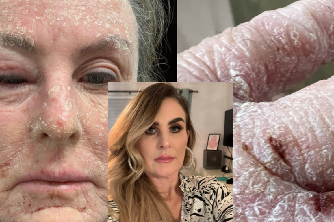 Scots mum with eczema says using steroid creams for 40 years 'has ruined life'