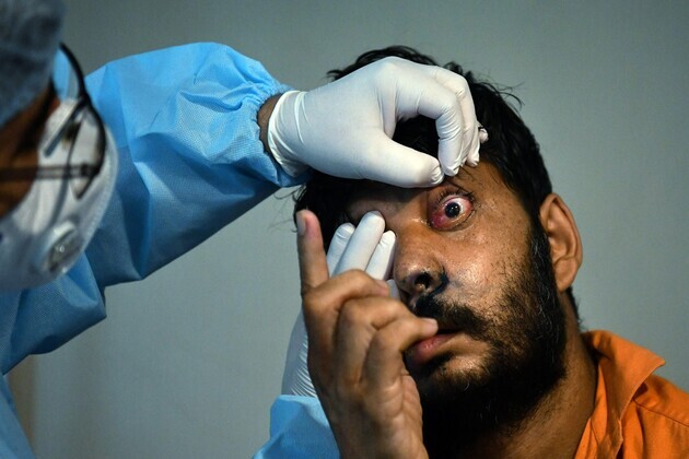 Researchers urge for microbiology-guided diagnosis following discovery of drug-resistant eye pathogens
