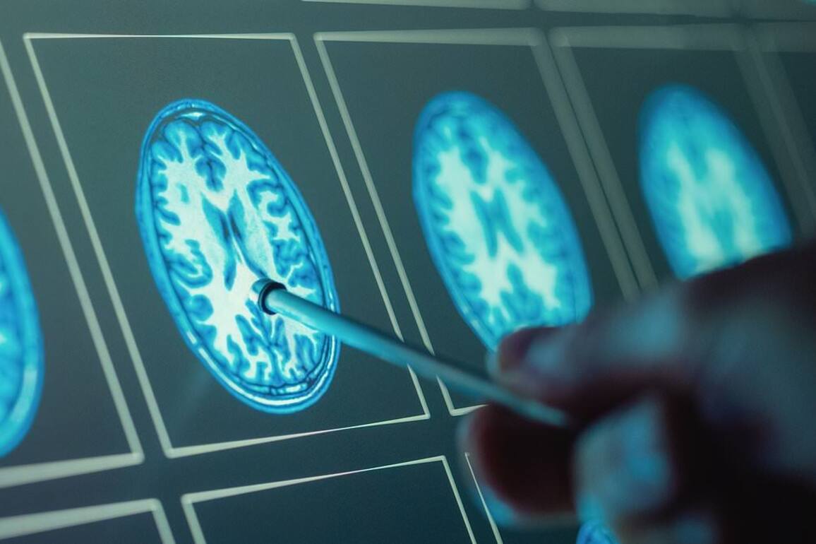 Experts warn virus that almost all of us have caught may dramatically raise risk of young dementia