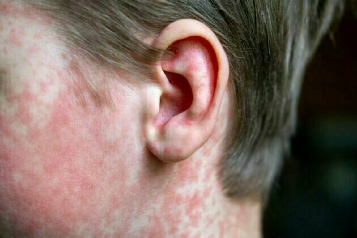 Child dies from complications of measles years after infection - SSPE explained