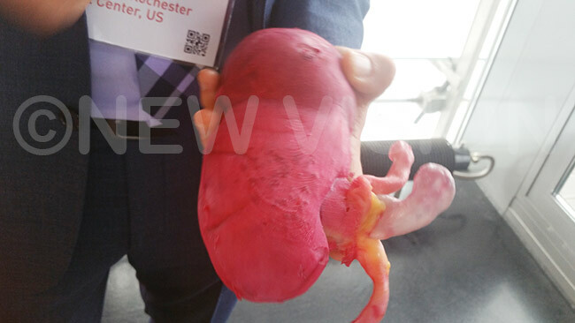  hazi displays a replica of a the kidney of a cancer patient who underwent an operation