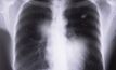 Qld govt moves to tackle black lung threat