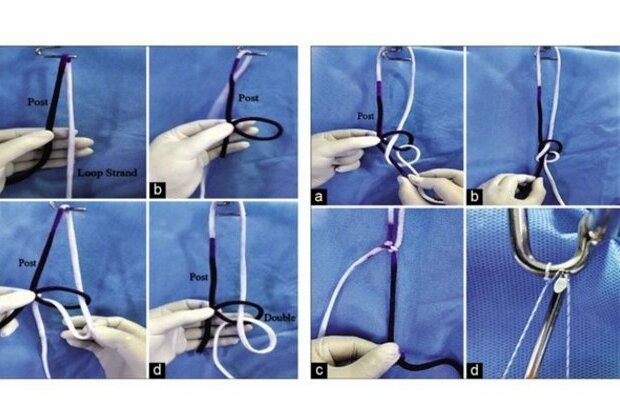 Doctor at Sakra World Hospital invents a new form of Arthroscopy knot - The Banarji's Knot