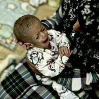 Images of Gaza's starving babies have gone round the world. This is what malnutrition does in the first 1,000 days of life