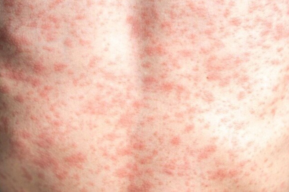 Arizona measles outbreak prompts surveillance toolkit  