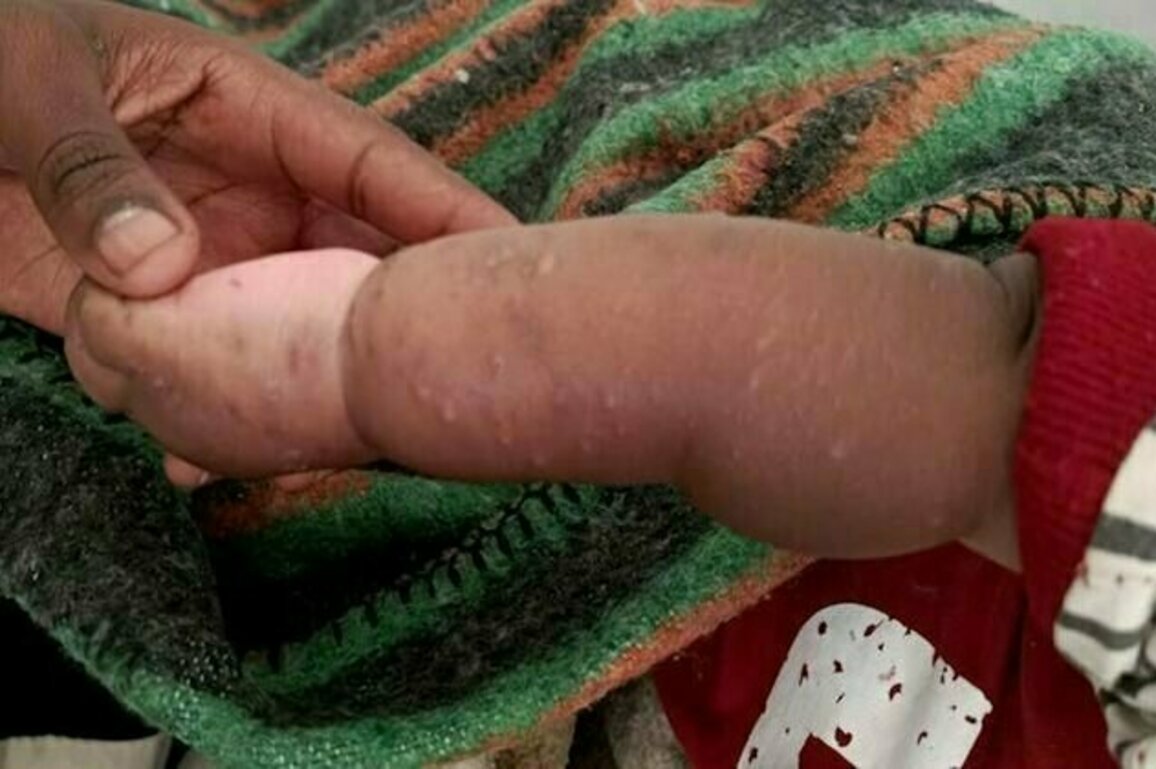 Mpox en Sierra Leone : les raisons de la recente recrudescence et les risques pour l'Afrique de l'Ouest