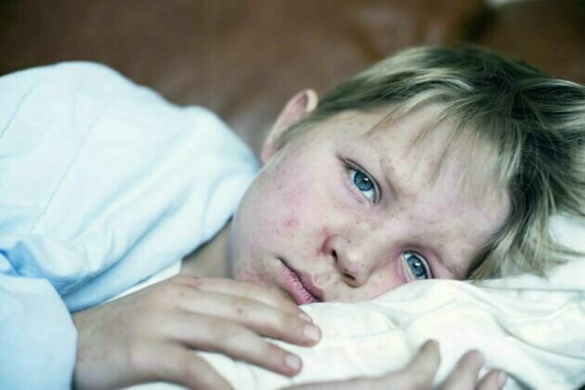 New measles cases in Queensland show 'herd immunity' is more important than ever