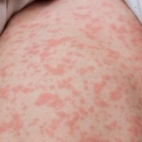 Winnipeg locations among latest measles exposure sites in Manitoba
