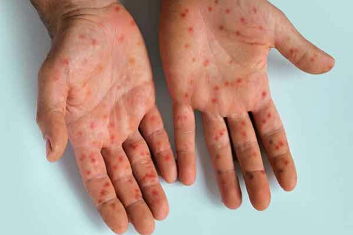 US records over 800 confirmed cases of measles this year