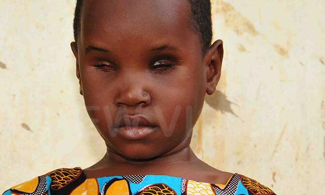 Five year-old girl loses eyes to cancer, seeks financial help Five year-old girl loses eyes to cancer, seeks financial help