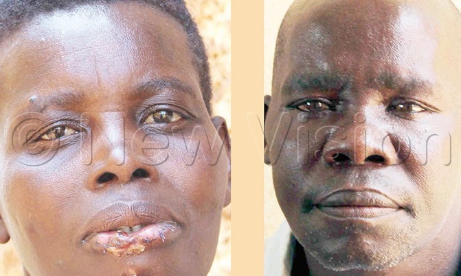 Man bites wife's lip over sh200 Man bites wife's lip over sh200