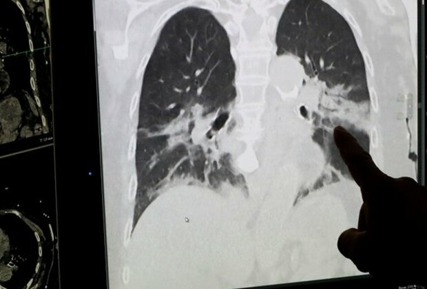 COVID-19 Omicron variant lung damage 'milder than Delta in animals': Study