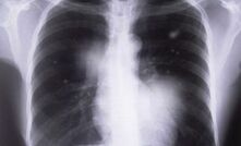 Qld black lung cases shatters faith in state's safety system