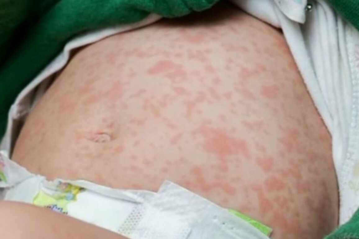 Alberta reports 19 new cases of measles, surpassing 500 confirmed infections