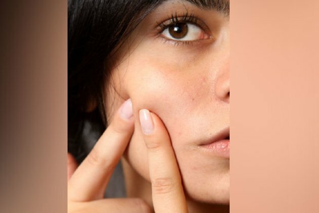 Do you know daily consumption of sweets and cakes can cause acne?