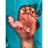Doctors reconstruct thumb from 20-year-old man's amputated leg in Delhi