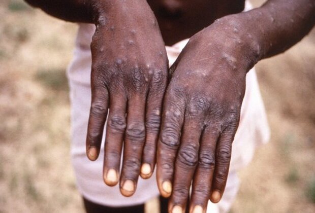 No diagnostic facility in Pakistan to detect Monkeypox