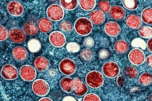 WHO Renames Monkeypox as Mpox, Citing Racism Concerns