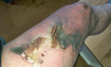  A mine site worker has caught national health and safety attention after an e-cigarette exploded while he was on the job.