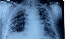 Chest X-ray of a patient diagnosed with silicosis