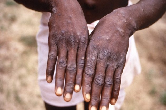 Centre alerts NCDC, ICMR on monkeypox: Sources