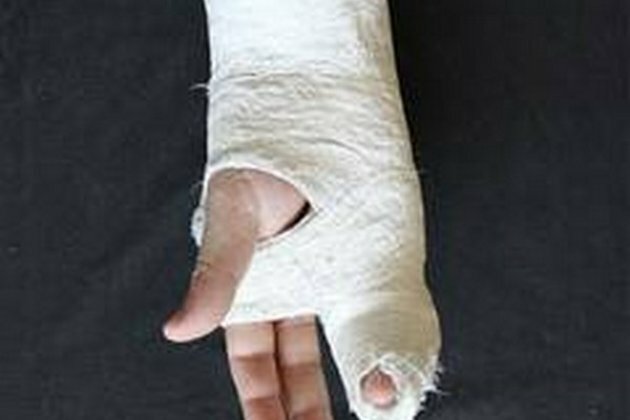 Speeding up bone implant recover with breakthrough discover