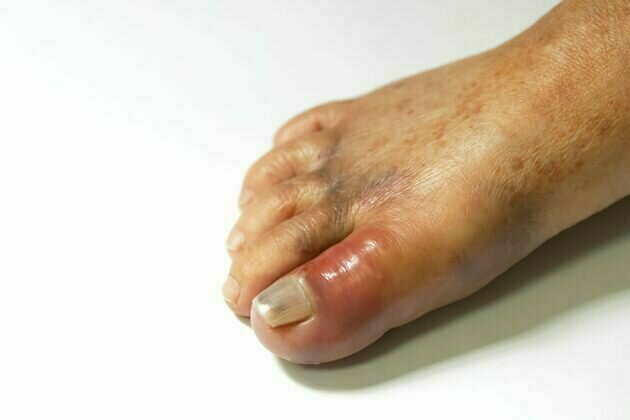 Gout used to be an affliction of royalty but is now a disease of the masses