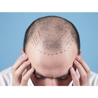 Dermatologist vs. Hair Transplant Surgeon: Who's Best for Hair Transplant Surgery?