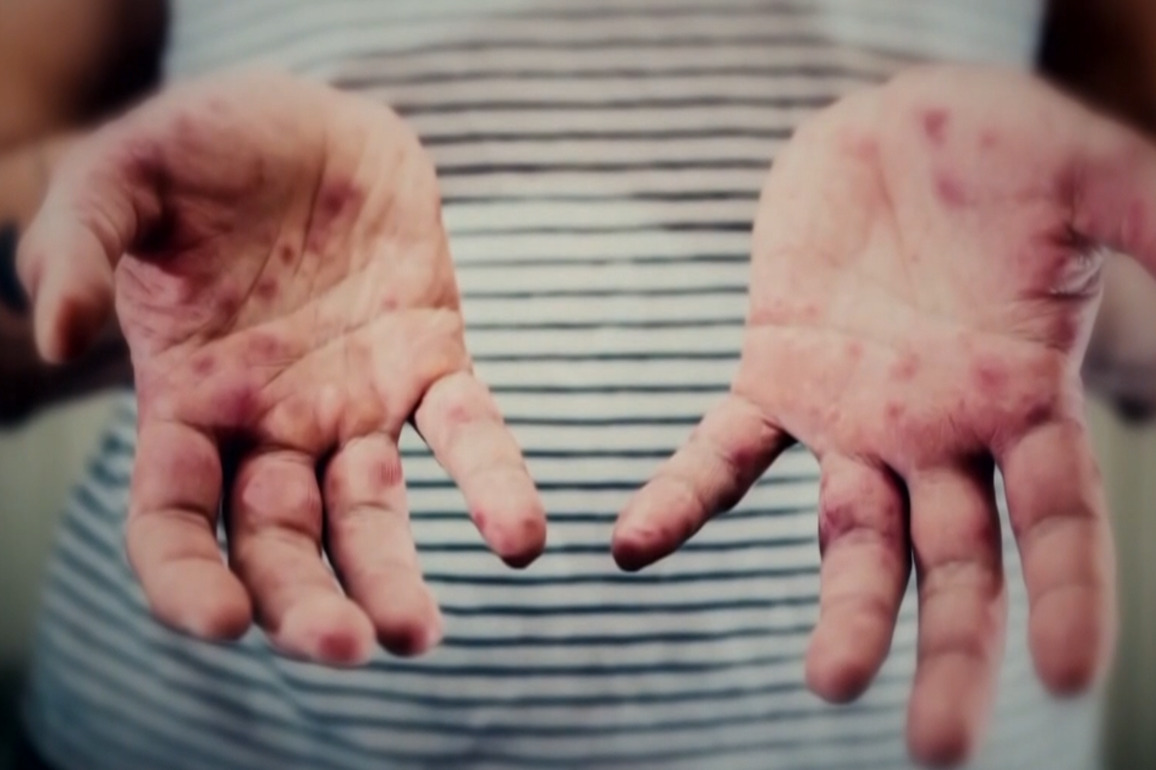 NC hospitals in state of standby, preparing as measles threat grows
