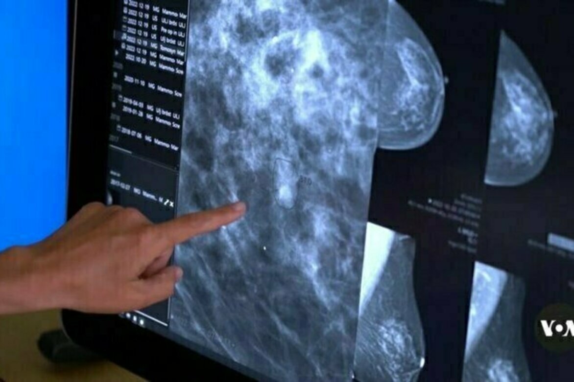 Does AI detect breast cancer better than doctors can