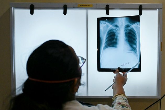 COVID-19, Global Crises Hinder Progress in Ending TB