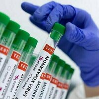 Ghana reported 45 confirmed cases of monkeypox in past month