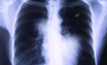 Some Queensland coal miners have been diagnosed with black lung.