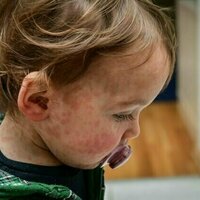 Measles cases are surging globally. Should children be vaccinated earlier?
