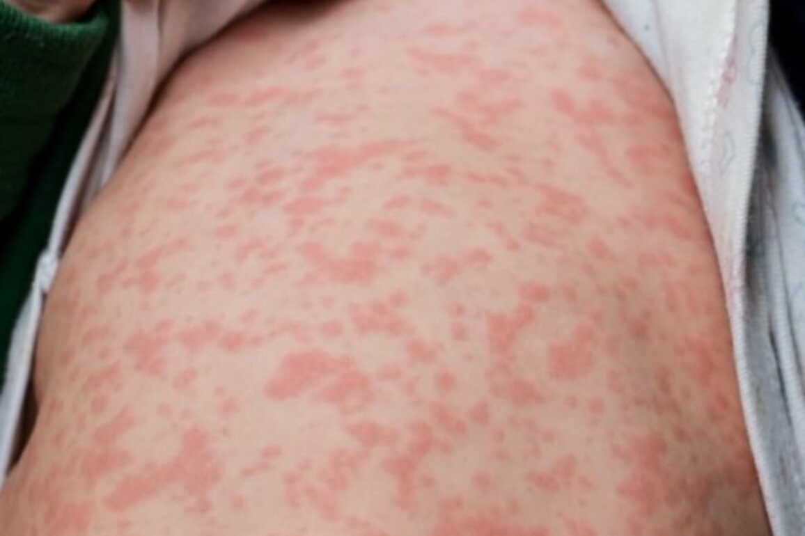 Winnipeg locations among latest measles exposure sites in Manitoba