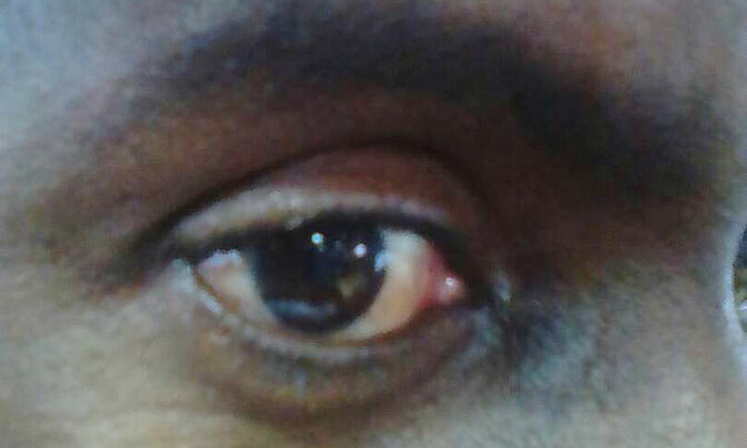 Uganda has only 40 eye specialists Uganda has only 40 eye specialists