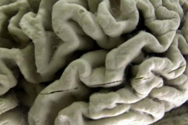 Depression may speed brain aging: research