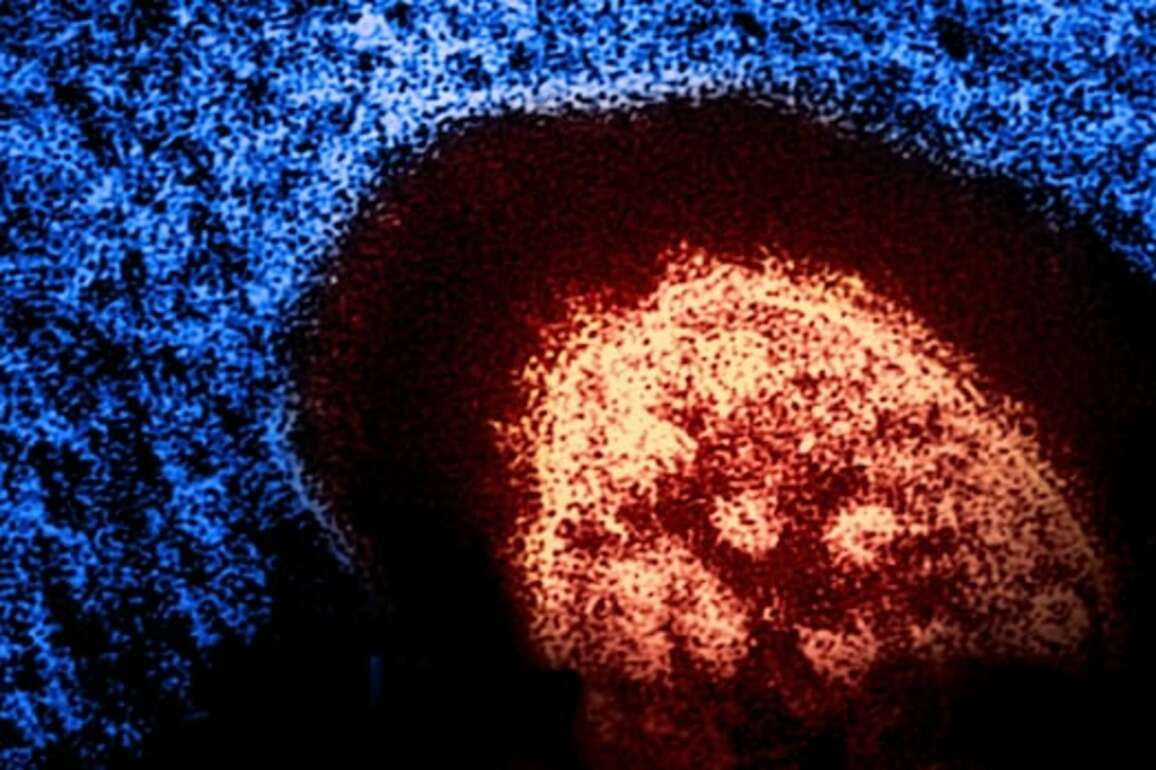 Measles may be circulating in small northeast B.C. community, says health authority